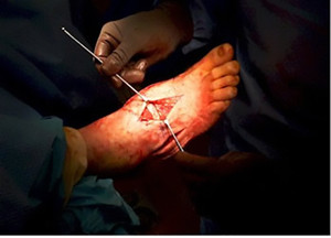 Sports Surgery Pic 3 - charcot foot surgery