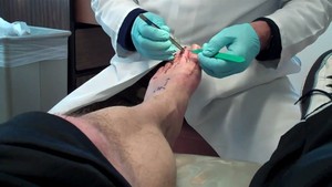 Sports Surgery Pic 4 - hammer toe correction surgery