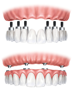 SA Precision Dentures Pic 4 - Implant Retained Dentures