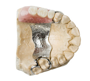 SA Precision Dentures Pic 2 - Partial Chrome Dentures