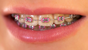 Currumbin Fair Dental Pic 3 - Dr Raymond Boctor Get Affordable Braces today payment plans available