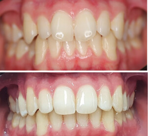 Paddington Dentistry Pic 3 - Invisalign treatment