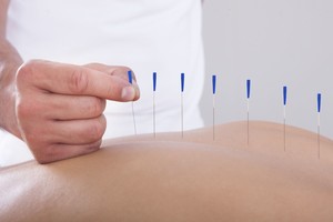 Relative Therapies Pic 3 - Acupuncture