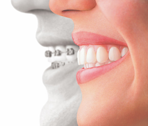 Dr Brett Kerr Pic 1 - Braces or Invisalign you can see the difference