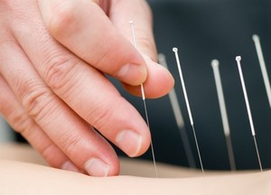 Gold Coast Chiropractic Care Pic 5 - Gentle acupuncture