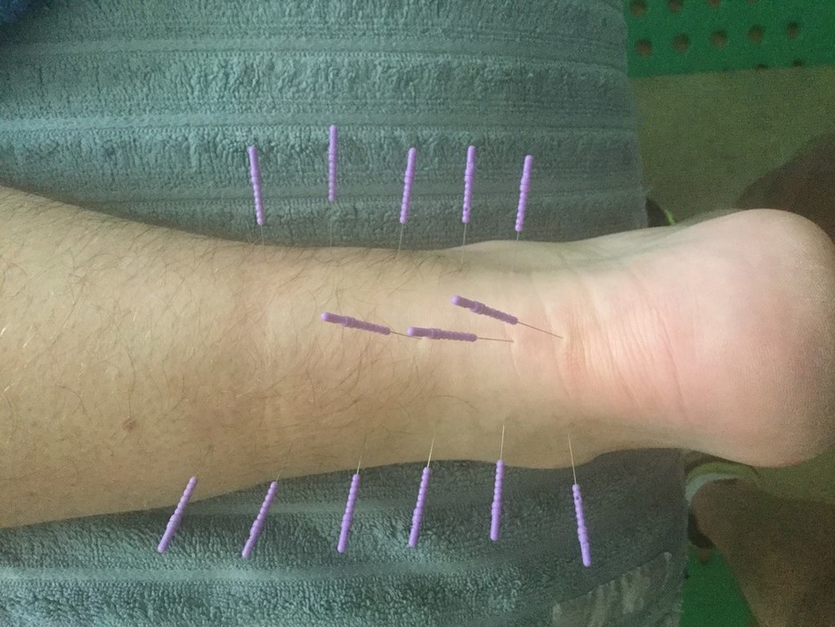 Body Assist Pic 1 - Myofascial dry needling to Achilles medial and lateral calf and ankle