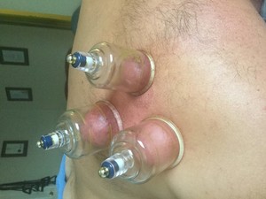 Body Assist Pic 2 - Cupping to the rotator cuff stretch and release