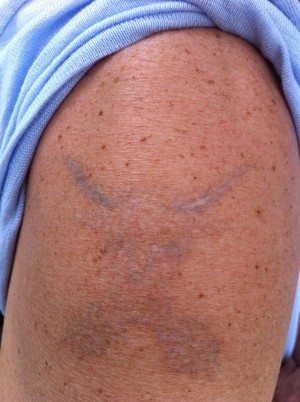 Tattoo Removal WA Pic 3 - Bull Tattoo Removal after 4 sessions