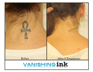 Vanishing Ink - Tattoo Removal Clinic Pic 4 - Blue Neck Tattoo Before and After Photo