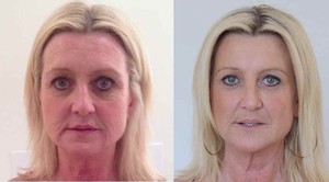 Cityskin Cosmetic Clinic Pic 3 - Before and after photos for antiwrinkle injections