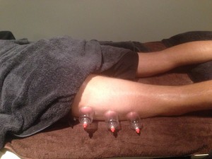 Body in Sync Health Studio Pic 4 - remedial cupping