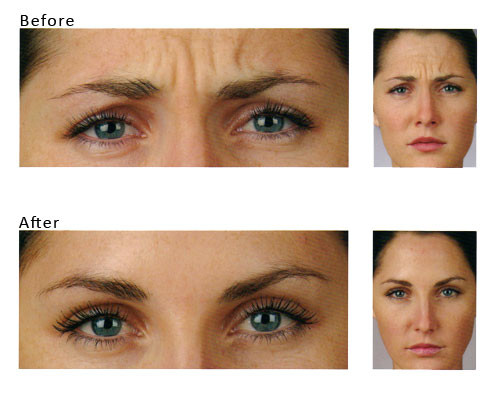 Renaissance Skin Care_ Cosmetic Injector Pic 1 - Botox_1 Warragul_Renaissance Skin Care