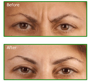 Renaissance Skin Care_ Cosmetic Injector Pic 2 - Botox_2 Warragul_Renaissance Skin Care