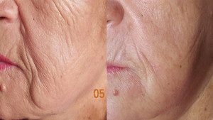 Face Boutique by Irina Pic 4 - Anti Aging Microdermabrasion Before and After Face Boutique by Irina