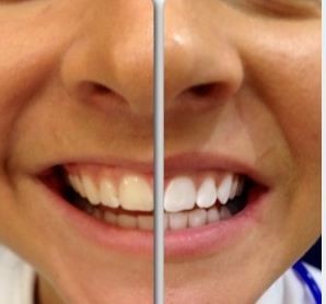 PureSmile Pty Ltd Pic 2 - before and after teeth white