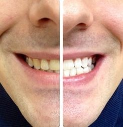 PureSmile Pty Ltd Pic 1 - before and after white teeth