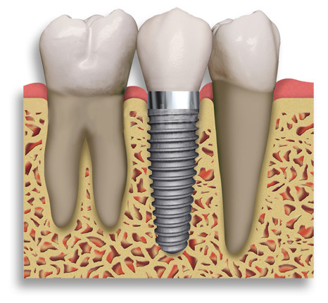 Enhance Dental Pic 1 - leading tooth implants