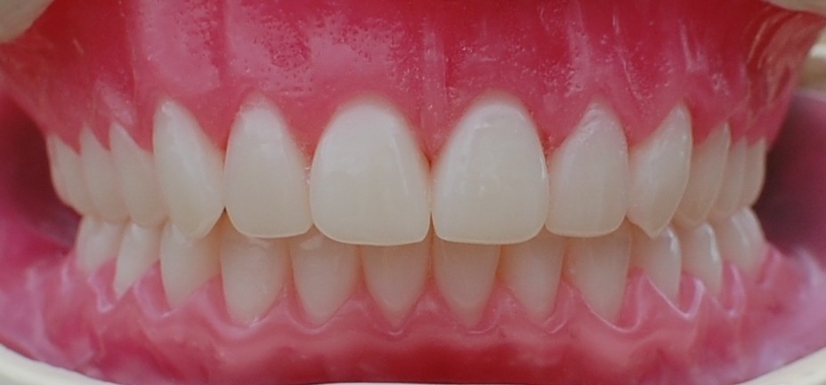 Denture Square Brisbane Pic 1 - Full Dentures