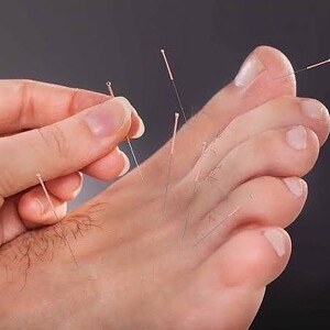 Luxe Feet Pic 3 - Dry Needling