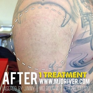 mj driver laser tattoo removal u0026 lightening sydney in alexandria mj driver laser tattoo removal u0026 lightening sydney in alexandria