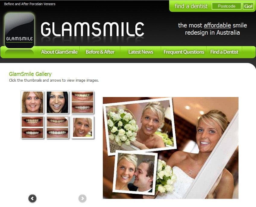 Glamsmile Veneers Australia Pic 1 - Glamsmile Porcelain Veneers