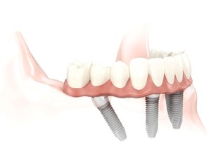 Impressions Dental Studio Pic 5 - Coordinated Treatment Planning for Implant Retained Dentures