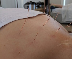 Caring Koala Wellness Centre Pic 4 - Dry Needling Acupuncture