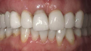 Smile Concepts Pic 2 - porcelain veneers before