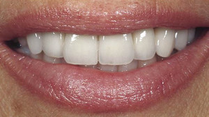 Smile Concepts Pic 3 - porcelain veneers after