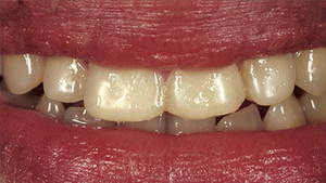 Smile Concepts Pic 4 - porcelain veneers 1 before