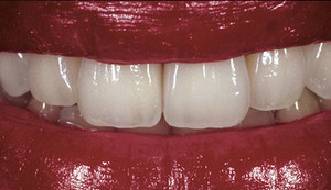 Smile Concepts Pic 5 - porcelain veneers 1 after