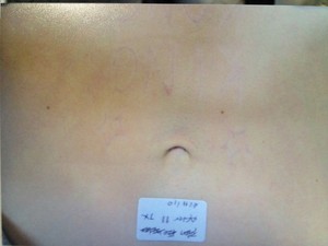 Instant Laser Clinic Pic 2 - After a course of 11 laser tattoo removal with Qswitch C6 Medlite