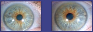 Sydney Iridology Pic 2