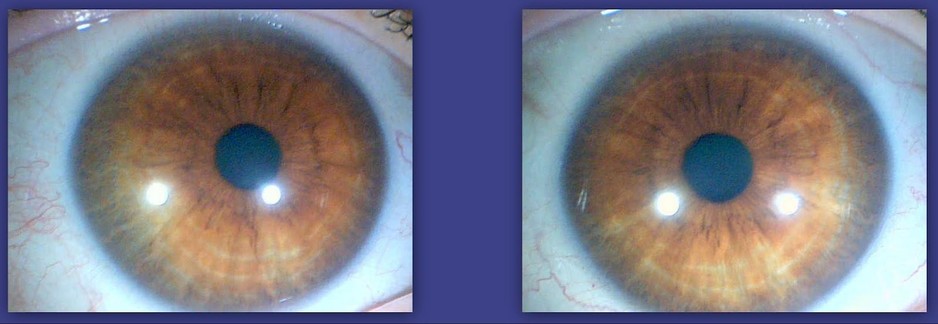 Sydney Iridology Pic 1