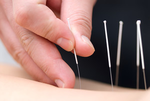 Perth Chiro Centre Pic 3 - We Offer Dry Needling Services