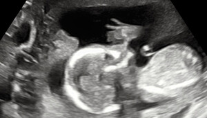 Babyview Pic 3 - 2D