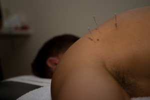 SportsMyo Pic 2 - Dry Needling of the Infraspinatus muscle