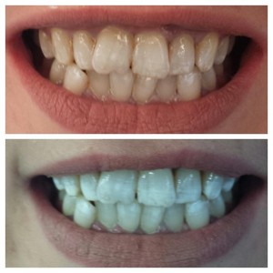 STUDIO 85 Pic 4 - Cosmetic Teeth Whitening BEFORE AFTER