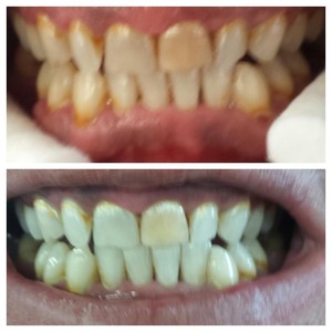 STUDIO 85 Pic 3 - Cosmetic Teeth Whitening BEFORE AFTER