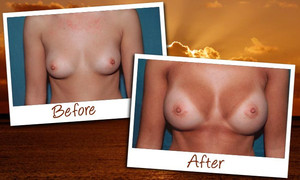 Designer Travel Group Pic 4 - Breast AugmentationImplants Before After Photos