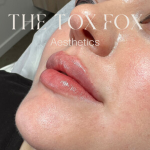 The Tox Fox | Cosmetic Injectables Pic 2