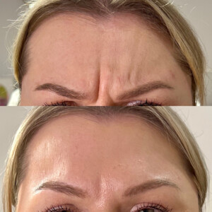 The Tox Fox | Cosmetic Injectables Pic 5