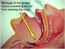 TMJ And Sleep Therapy Pic 2 - Sleep Apnoea