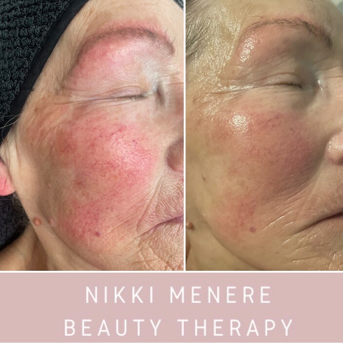 Nikki Menere Beauty Therapy Pic 1 - Before After an O Cosmedics facial A beautiful reduction in redness and gained hydration