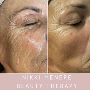 Nikki Menere Beauty Therapy Pic 2 - Beautiful reduction in wrinkle depth after an O Cosmedics facial