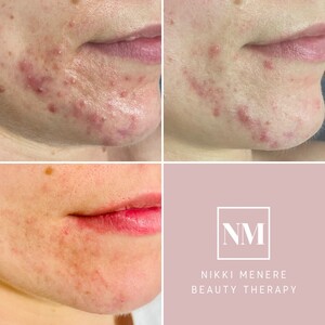 Nikki Menere Beauty Therapy Pic 4 - Progress with adult acne Its a work in progress but the results are beautiful