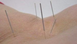 CTT Clinic Pic 2 - Acupuncture