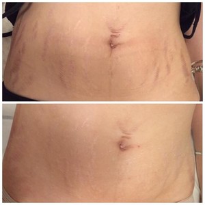 SJM Skin Aesthetics Pic 5 - 6 Treatments Skin Needling for stretch marks