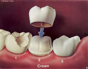 Bright Smile Dental Clinic Pic 5 - Dental Crown