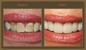 Bright Smile Dental Clinic Pic 4 - Dental Veneers